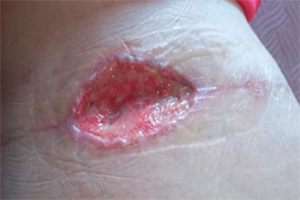 Deiscência de sutura